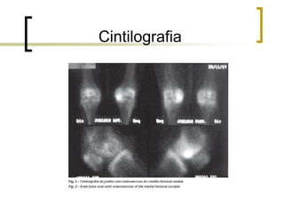 Cintilografia
 