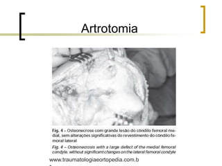 Artrotomia
www.traumatologiaeortopedia.com.b
 