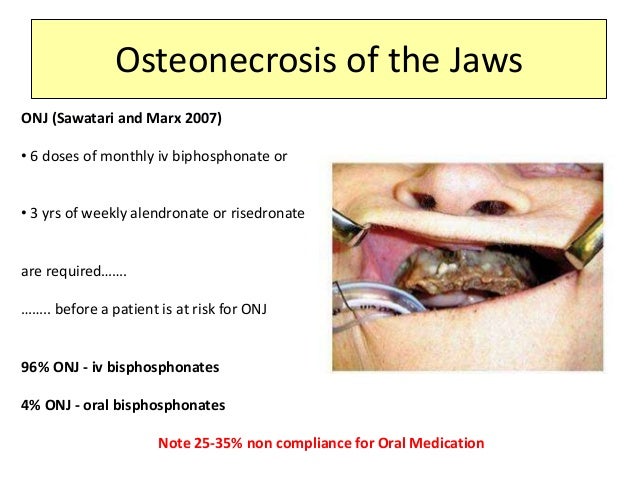 Fosamax Side Effects Jaw