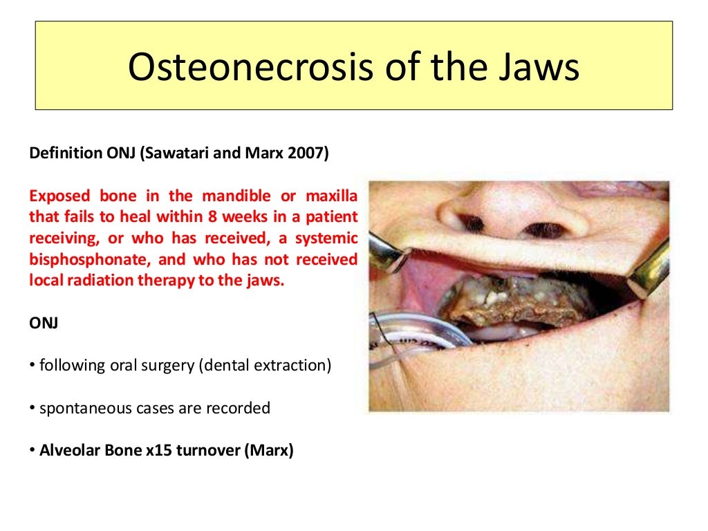 Osteonecrosis of the jaws