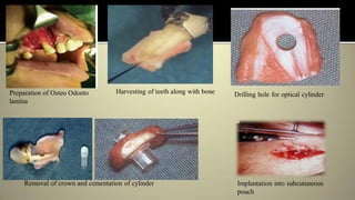 Preparation of Osteo Odonto
lamina
Harvesting of teeth along with bone Drilling hole for optical cylinder
Removal of crown and cementation of cylinder Implantation into subcutaneous
pouch
 