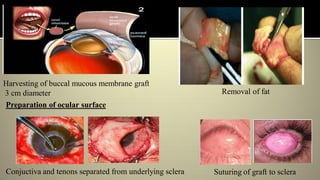 Preparation of ocular surface
Harvesting of buccal mucous membrane graft
3 cm diameter Removal of fat
Conjuctiva and tenons separated from underlying sclera Suturing of graft to sclera
 