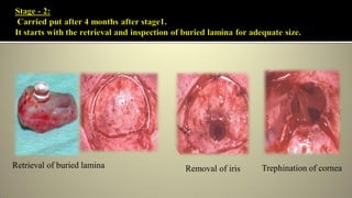 Retrieval of buried lamina Removal of iris Trephination of cornea
 