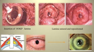 Lamina sutured and repositionedInsertion of OOKP lamina
 