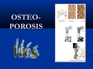 OOSSTTEEOO-- 
PPOORROOSSIISS 
 