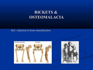 RRIICCKKEETTSS && 
OOSSTTEEOOMMAALLAACCIIAA 
DDeeff..:: rreedduuccttiioonn iinn bboonnee mmiinneerraalliizzaattiioonn !! 
 