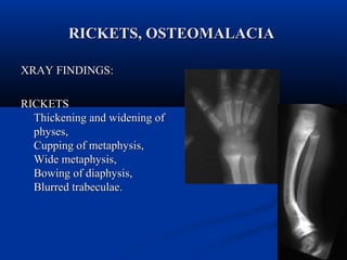 RRIICCKKEETTSS,, OOSSTTEEOOMMAALLAACCIIAA 
XXRRAAYY FFIINNDDIINNGGSS:: 
RRIICCKKEETTSS 
TThhiicckkeenniinngg aanndd wwiiddeenniinngg ooff 
pphhyysseess,, 
CCuuppppiinngg ooff mmeettaapphhyyssiiss,, 
WWiiddee mmeettaapphhyyssiiss,, 
BBoowwiinngg ooff ddiiaapphhyyssiiss,, 
BBlluurrrreedd ttrraabbeeccuullaaee.. 
 