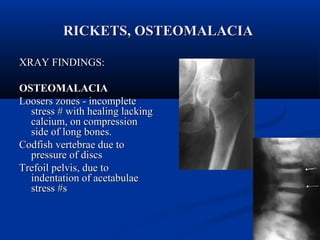 RRIICCKKEETTSS,, OOSSTTEEOOMMAALLAACCIIAA 
XXRRAAYY FFIINNDDIINNGGSS:: 
OOSSTTEEOOMMAALLAACCIIAA 
LLoooosseerrss zzoonneess -- iinnccoommpplleettee 
ssttrreessss ## wwiitthh hheeaalliinngg llaacckkiinngg 
ccaallcciiuumm,, oonn ccoommpprreessssiioonn 
ssiiddee ooff lloonngg bboonneess.. 
CCooddffiisshh vveerrtteebbrraaee dduuee ttoo 
pprreessssuurree ooff ddiissccss 
TTrreeffooiill ppeellvviiss,, dduuee ttoo 
iinnddeennttaattiioonn ooff aacceettaabbuullaaee 
ssttrreessss ##ss 
 