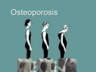 Osteoporosis

{

 
