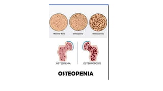 Osteopenia cuando la densidad del hueso
es menor a lo normal, entre 1 y 2,5 puntos
mayor a 2,5 puntos, se considera
Osteop...