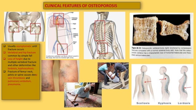 Osteopenia Tibia Osteopenia and osteoporosis | PPTX | Menopause | Endocrine and ...