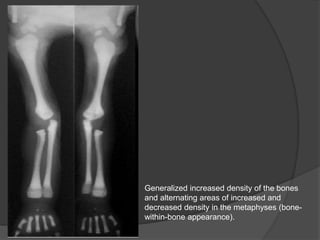 Generalized increased density of the bones
and alternating areas of increased and
decreased density in the metaphyses (bone-
within-bone appearance).
 