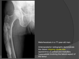 Melorheostosis in a 77-year-old man.
Anteroposterior radiographs demonstrate
the classic dripping candle wax
appearance of cortical and medullary
hyperostosis involving the lateral aspect of
the femur
 