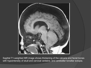Sagittal T1-weighted MR image shows thickening of the calvaria and facial bones
with hypointensity of skull and cervical vertebra, and cerebellar tonsillar ectopia.
 