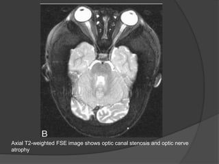 Axial T2-weighted FSE image shows optic canal stenosis and optic nerve
atrophy
 