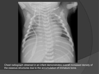 Chest radiograph obtained in an infant demonstrates overall increased density of
the osseous structures due to the accumulation of immature bone.
 