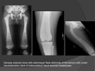 Densely sclerotic bone with erlenmeyer flask deformity of the femurs with under-
tubulularization (lack of trabeculation) block femoral meatphyses.
 
