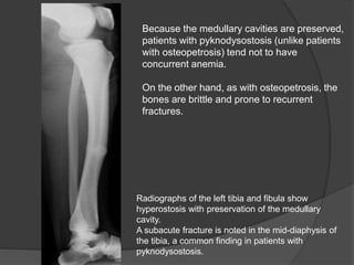 Radiographs of the left tibia and fibula show
hyperostosis with preservation of the medullary
cavity.
A subacute fracture is noted in the mid-diaphysis of
the tibia, a common finding in patients with
pyknodysostosis.
Because the medullary cavities are preserved,
patients with pyknodysostosis (unlike patients
with osteopetrosis) tend not to have
concurrent anemia.
On the other hand, as with osteopetrosis, the
bones are brittle and prone to recurrent
fractures.
 