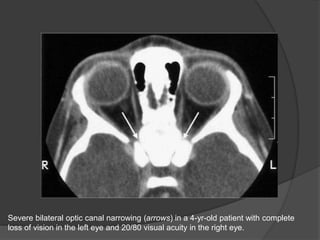 Severe bilateral optic canal narrowing (arrows) in a 4-yr-old patient with complete
loss of vision in the left eye and 20/80 visual acuity in the right eye.
 
