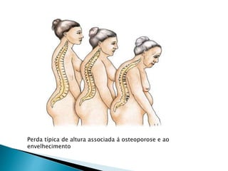 Perda típica de altura associada á osteoporose e ao
envelhecimento
 