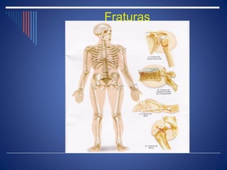 Fraturas
 