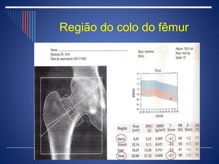 Região do colo do fêmur
 