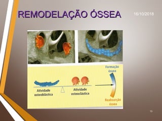 13
REMODELAÇÃO ÓSSEAREMODELAÇÃO ÓSSEA 16/10/2018
 