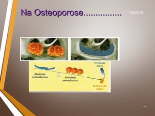 14
Na Osteoporose................Na Osteoporose................ 11/06/18
 
