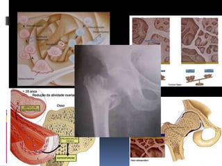 Teoria Hormonal Pós menopausa                                                 Deficiência de Estrógenos                                            Reabsorção de osso com liberação                                                              cálcio e fósforo                                       Decréscimo de Hormônio da Paratireóide                                        Decréscimo de 1-hidroxilação do calcidiol                                                        Decréscimo do calcitriol                                                   decréscimo da absorção de cálcio