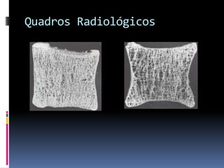 Ultrassonometria óssea