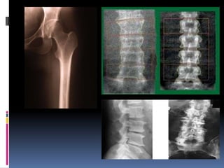 Densitometria óssea (padrão-ouro)Índice de Singh