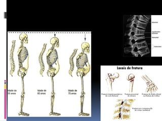 Tipo IIEpidemiologiaSexo RaçaIdadeLocalização das fraturas