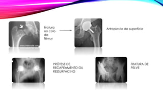 Fratura
no colo
do
fêmur
Artroplastia de superfície
PRÓTESE DE
RECAPEAMENTO OU
RESSURFACING
FRATURA DE
PELVE
 