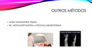 OUTROS MÉTODOS
• ULTRA SONOMETRIA ÓSSEA;
• RX, HISTOMORFOMETRIA e PROVAS LABORATORIAIS
 