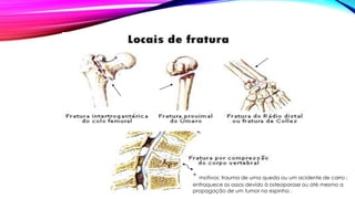 * motivos: trauma de uma queda ou um acidente de carro ;
enfraquece os ossos devido à osteoporose ou até mesmo a
propagação de um tumor na espinha .
 