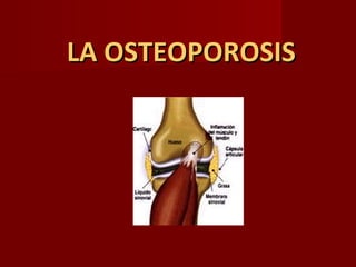 LA OSTEOPOROSISLA OSTEOPOROSIS
 