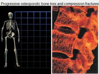 Secondary to an underlying disease