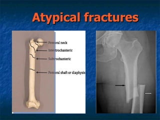 Atypical fractures  