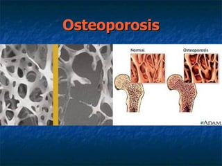 Osteoporosis  