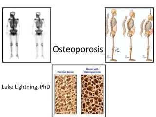 Osteoporosis

                       Luke Lightning

Luke Lightning, PhD
 