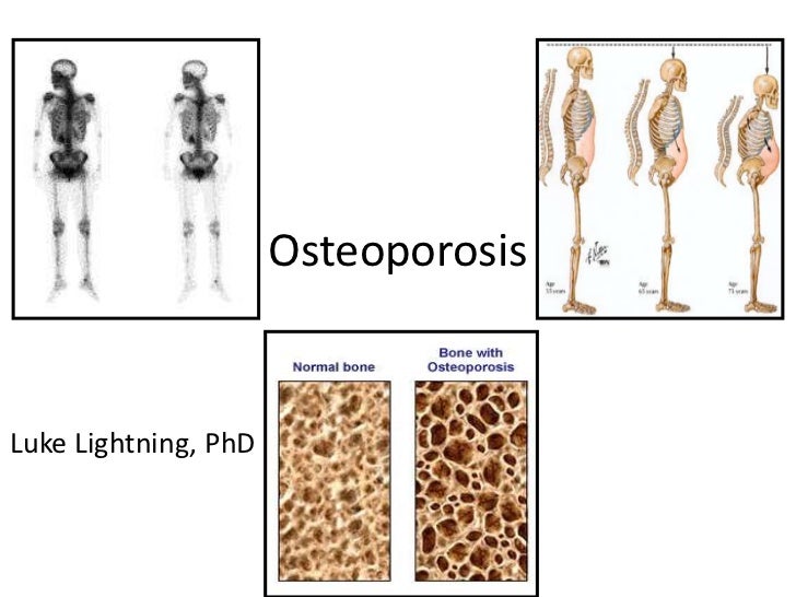 Osteoporosis Therapy Overview