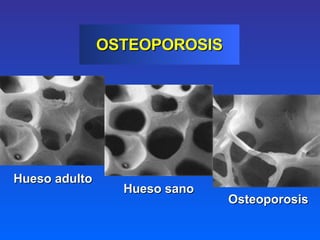 OSTEOPOROSIS Hueso sano Osteoporosis Hueso adulto 