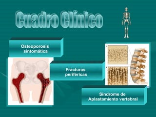 Cuadro Clínico Síndrome de  Aplastamiento vertebral Fracturas  periféricas Osteoporosis sintomática 