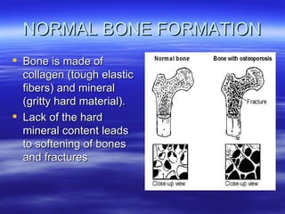 NORMAL BONE FORMATION Bone is made of collagen (tough elastic fibers) and mineral (gritty hard material). Lack of the hard mineral content leads to softening of bones and fractures 