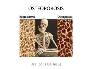 OSTEOPOROSIS




Dra. Zoila De Jesús
 