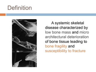 Definition

                 A systemic skeletal
             disease characterized by
             low bone mass and micro
             architectural deterioration
             of bone tissue leading to
             bone fragility and
             susceptibility to fracture
 
