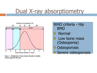 Dual X-ray absorptiometry

             WHO criteria - Hip
              BMD
               Normal
               Low bone mass
              (Osteopenia)
              Osteoporosis
              Severe osteoporosis
 