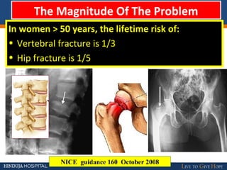 The Magnitude Of The Problem
In women > 50 years, the lifetime risk of:
• Vertebral fracture is 1/3
• Hip fracture is 1/5
NICE guidance 160 October 2008
 