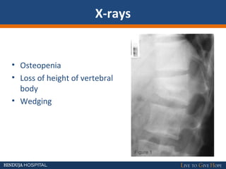 X-rays
• Osteopenia
• Loss of height of vertebral
body
• Wedging
 