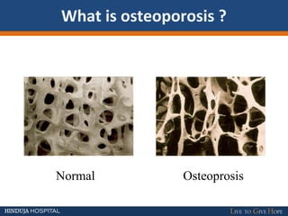 What is osteoporosis ?
Normal Osteoprosis
 